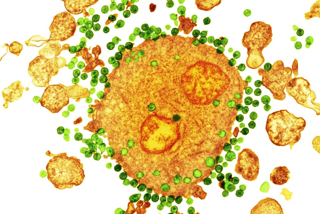 A colored transmission electron micrograph of the H.I.V. virus, in green, attaching to a white blood cell, in orange.CreditCreditNIBSC/Science Source